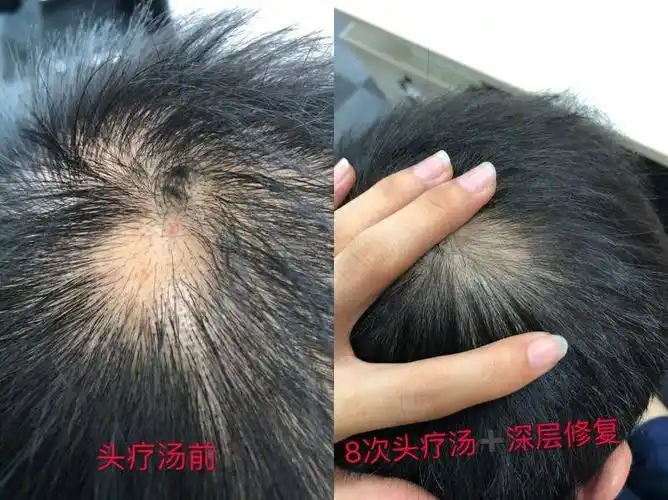头皮毛囊炎半个疗程好了,而且脱发也好多了哦 可以长新发的头疗汤