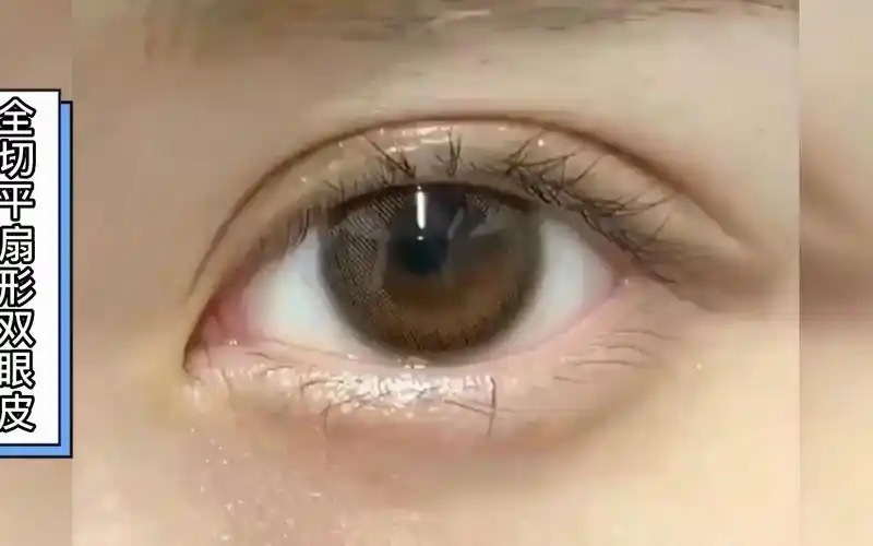 全切平扇形双眼皮半年术后反馈,深圳王医生作品