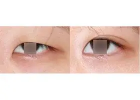 眼睑下垂矫正前后对比图 >>>眼睑下垂矫正案例   眼睑下垂矫正介绍