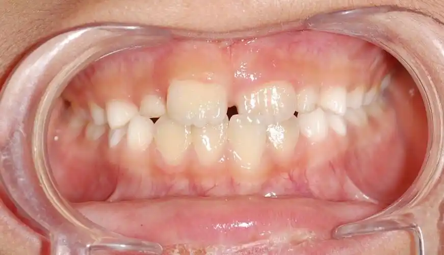 左上中切牙被包住了,叫个别牙地包天,也需要矫治除了看牙齿咬合,还有