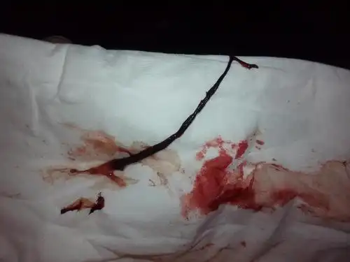 有类似情况的吗,婆婆说不是流出来了,流出来会大量出血