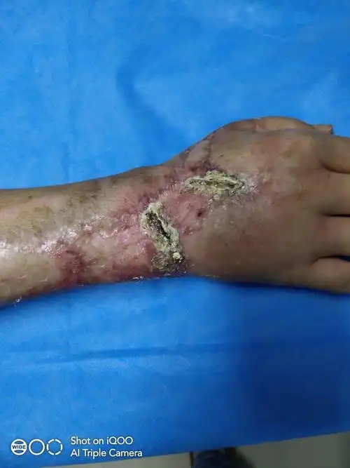 前臂机器绞伤患者的治疗心得体会一例