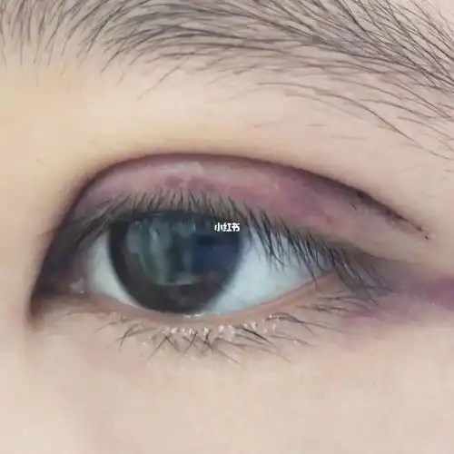 微创三点式双眼皮第三天