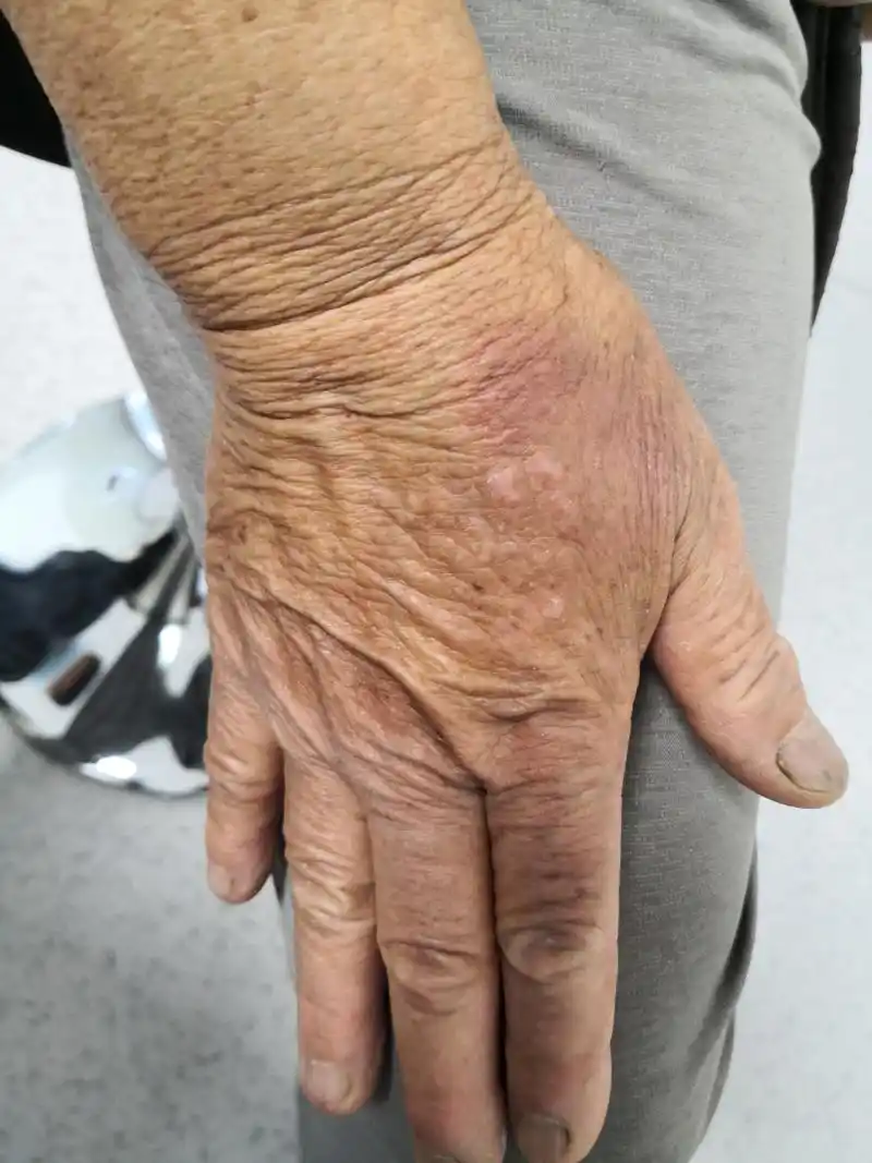 接触性皮炎#解决皮肤问题专注皮肤美容##皮肤##过敏