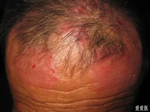 看图识病--------头皮部痒疹 - 皮肤及性传播疾病讨论版 - 爱爱医医学