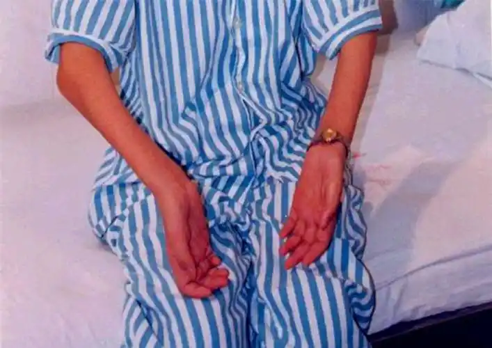 重症肌无力老专家刘泉鹏肌营养不良的类型都有哪些呢有什么表现