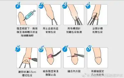 包皮手术过程