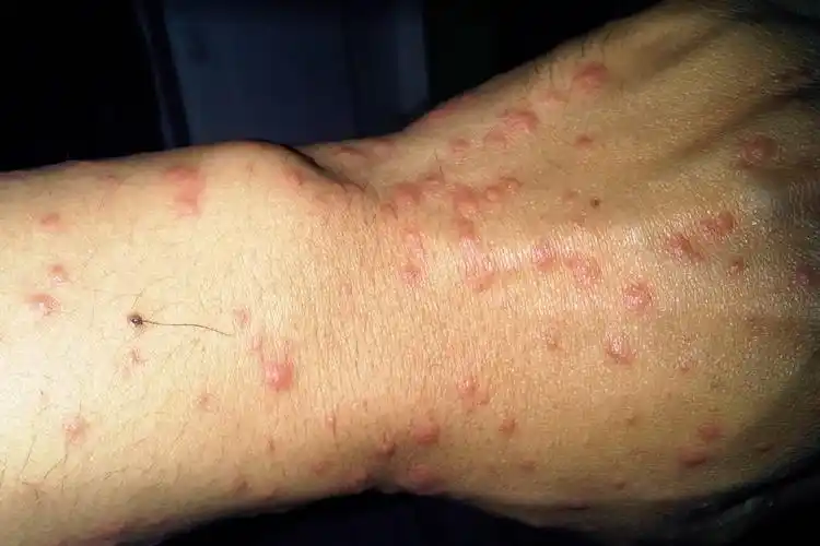 疱疹与过敏性皮炎图片比较