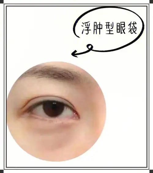 想要消灭眼袋,那我们必须先要了解眼袋1,浮肿型眼袋(如图1)浮肿型眼