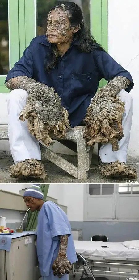 组图:世界7大最奇怪的皮肤病