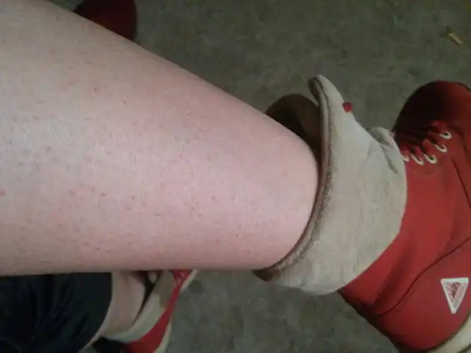 腿上的毛孔堵塞样,没长出来就看起很不雅观,怎么方法才能让他长出来