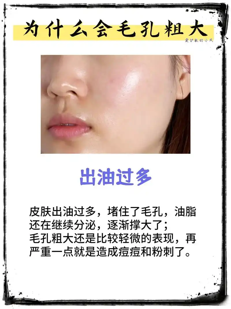 毛孔粗大,是很多人的 - 抖音
