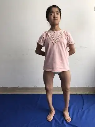 典型病例——"o"形,"k"形,"x"形腿