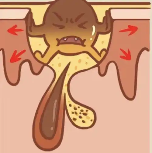 🍓黑头多毛孔粗大?千万别做这件事让你草莓变圣女果✔_圈子-新氧