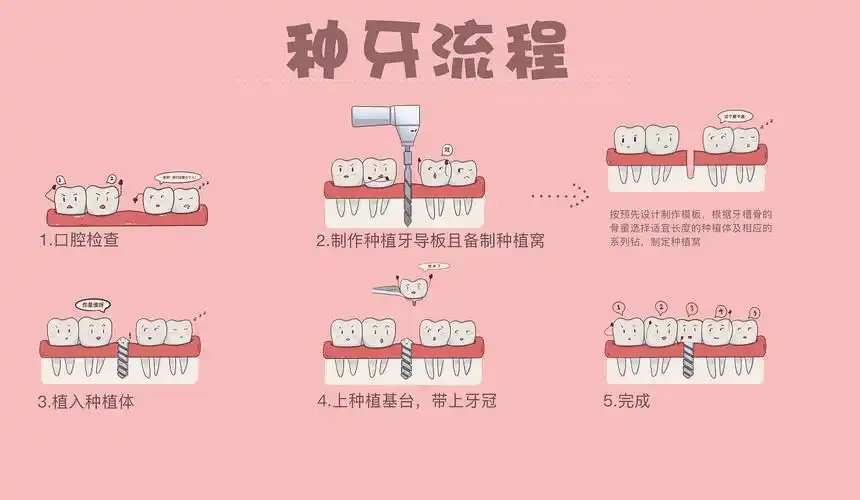 种牙流程
