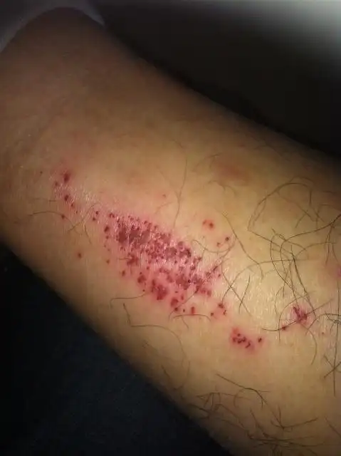 我的小腿先是痒,抓伤后就成了这样?这是怎么回事