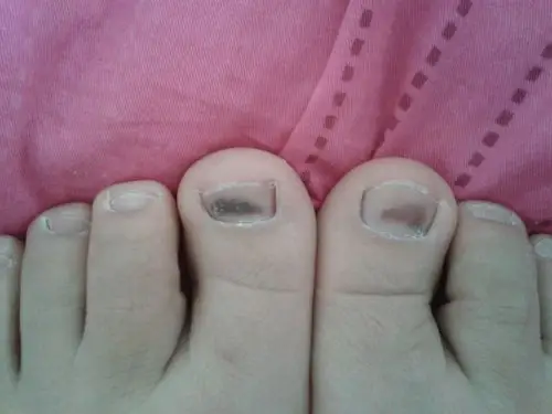 不会是灰指甲吧?