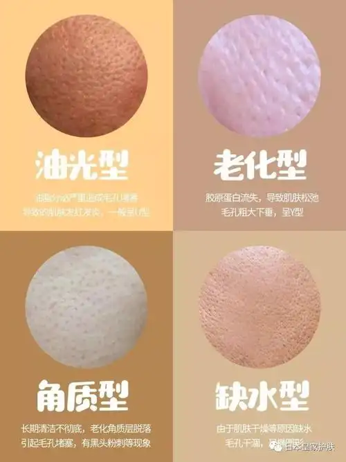 其实,毛孔粗大分多种类型,各自有不同的成因,只有"对症下药",才能从