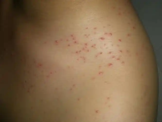 马拉色菌毛囊炎1例