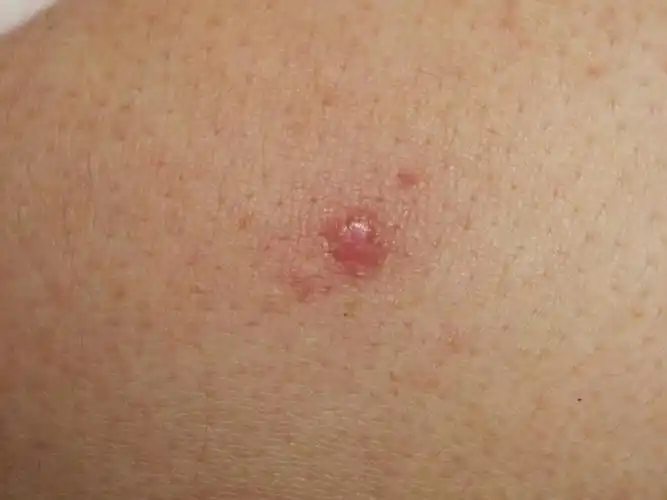 胸口反复在同一位置长个红痘痘,请问,这个是什么哦,不会是什么怪病吧.