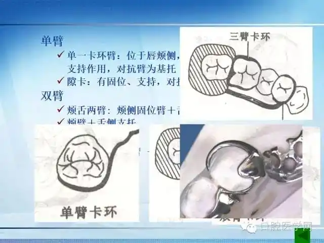 【多图】可摘局部义齿-卡环的种类