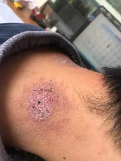 脖子后面的藓好久