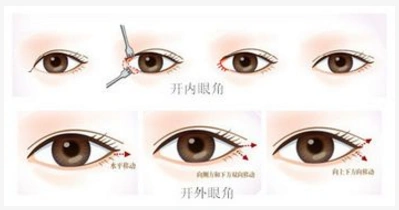 成镇模院长开外眼角手术的优点是什么
