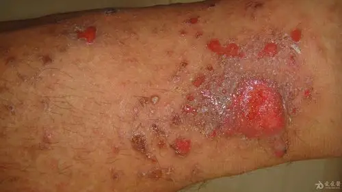 传染性湿疹样皮炎