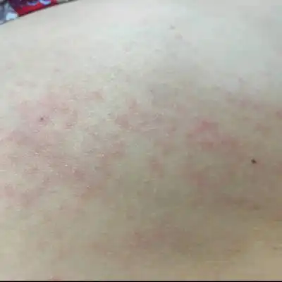 怀孕六个月左右昨天下午肚子两侧起了这个;以为衣服过敏换了;今天还是