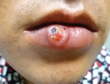 一期梅毒(又称硬下营):典型的梅毒表现为生殖器不痛不痒的皮肤溃疡.