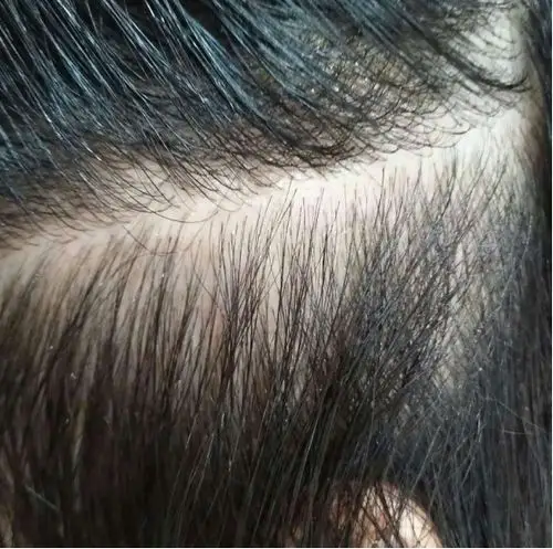 轻满多肽清螨抑菌套装祛除头发螨虫带来健康发质