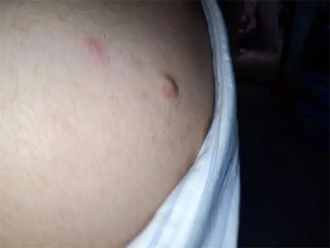 女子肩部脂肪瘤图片