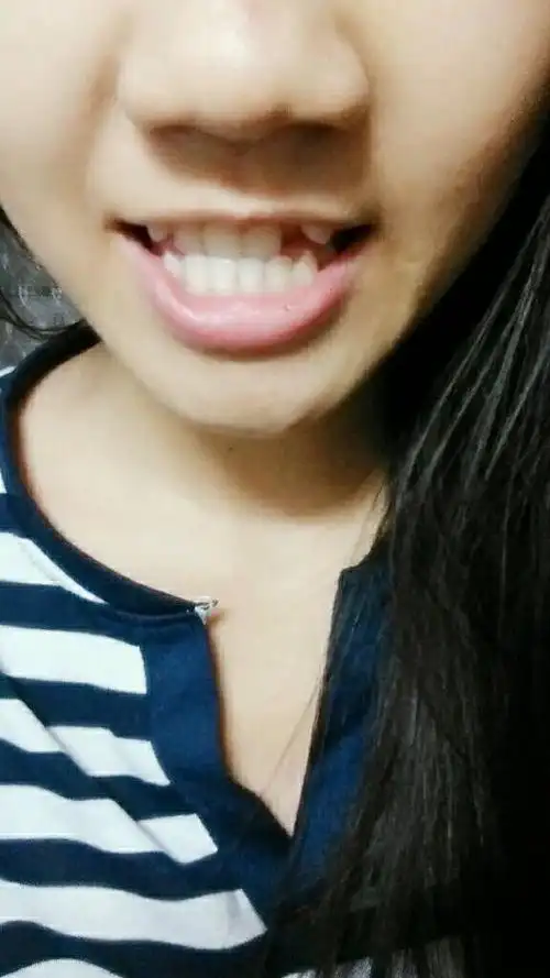 会不会比一般的牙齿更 长了虎牙,还有一颗塌进去了,下排齿突出,上排齿