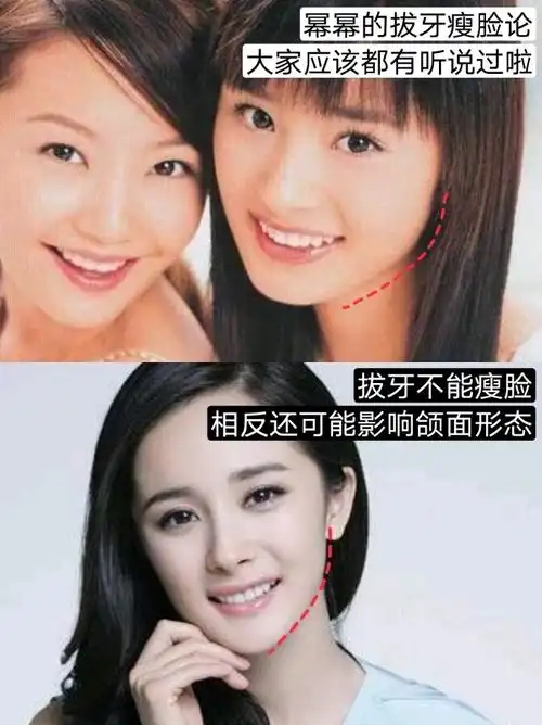 杨幂的拔牙瘦脸论大家应该都听过, 虽然脸还是靠下颌角整形瘦下去的