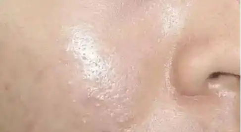 为啥皮肤出油,还有那多痘痘?