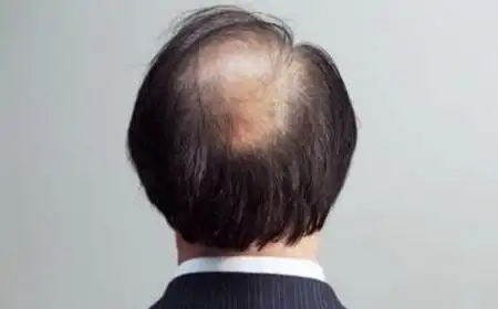 遗传性脱发能治吗 脱发会遗传吗