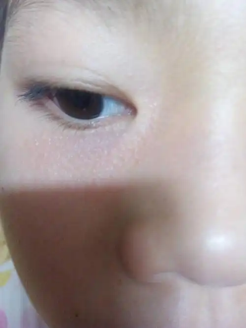 我女儿的眼睛眼皮下面长了很多小的颗粒是怎么啦