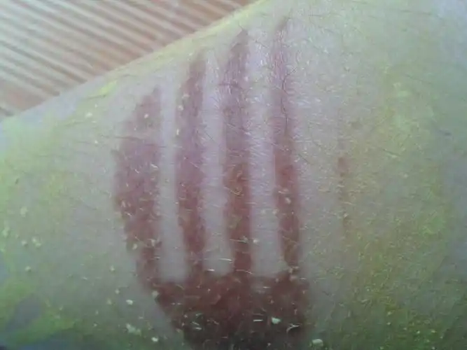 伤口烫伤十天星期左右,皮肤一直发黑怎么办?急,求好心人回答