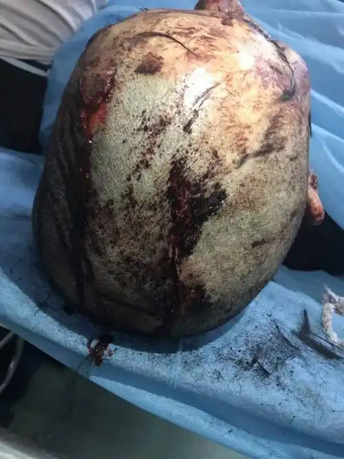 在洗澡的时候,被人砍伤.导致两个轻伤,二级,两个轻微伤.人跑了两