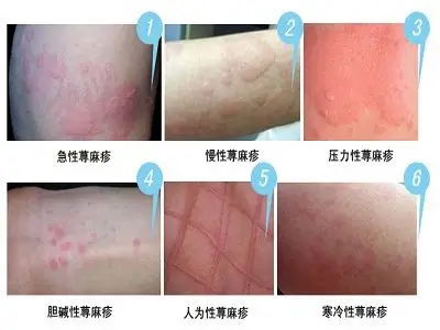 荨麻疹有哪些类型需要您了解的荨麻疹