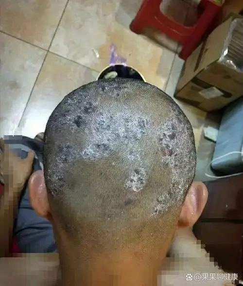 头上牛皮癣真的很痛苦,还好不困扰了 看不见.牛皮癣了