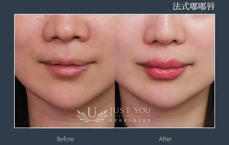 佳思优玻尿酸嘟嘟唇案例02