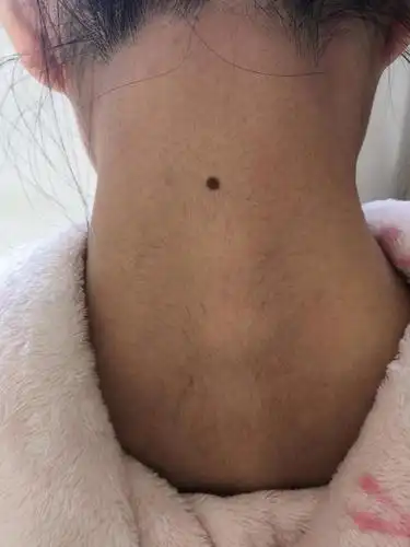 脖子上长了这样一个痣有什么说法吗