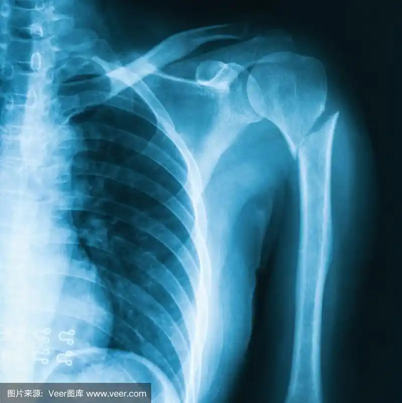 肱骨骨折x线照片.
