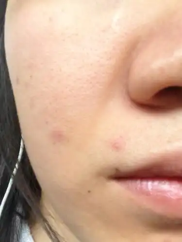 毛孔粗大,容易出油怎么办才好!