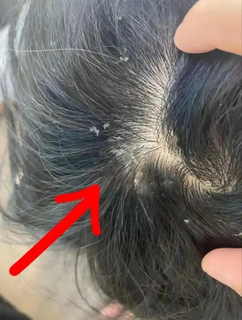 先搞清楚你是干性头皮屑还是油性头皮屑 96干性头屑大多是白色或