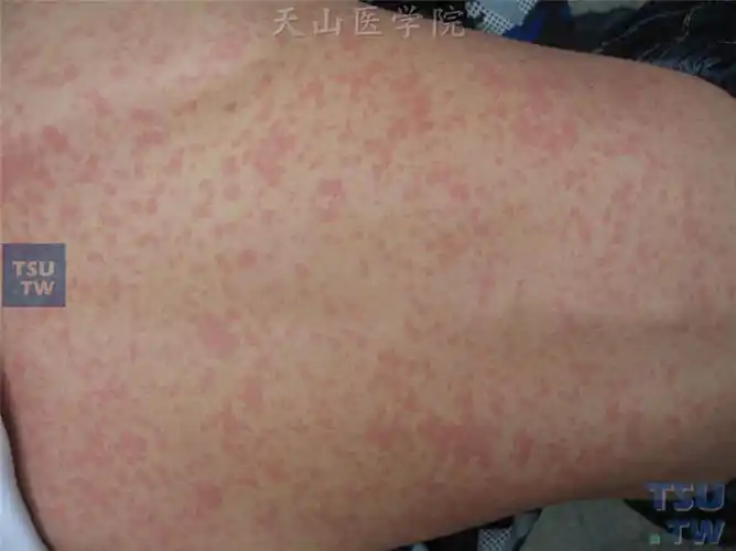 麻疹(measles)症状表现 - 皮肤病学 - 天山医学院