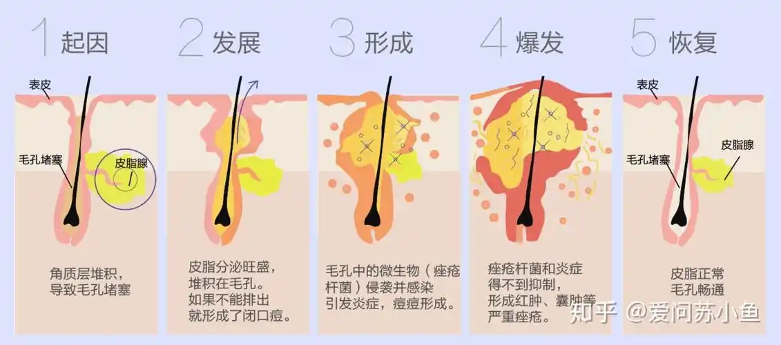 解密要想根治痘痘痤疮其实很简单首先你要弄懂为什么会长痘