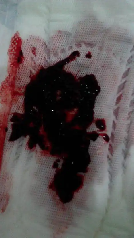 问:我今晚流的是这些血啊!好恐怖,我好怕