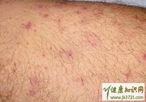 毛囊炎是艾滋病的症状吗,毛囊炎是艾滋病皮疹吗,全身毛囊炎是艾滋